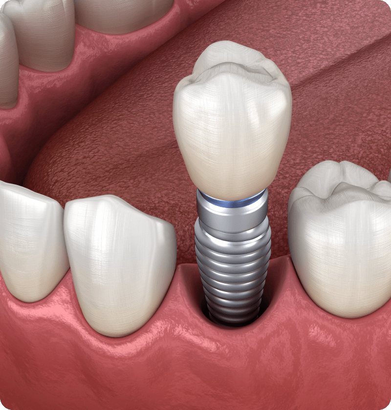 dental implant surgery