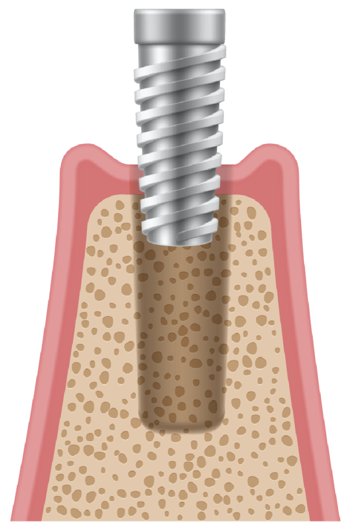 dental implant procedure: Exam & Diagnosis