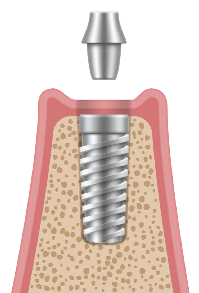 dental implant procedure: insert the dental implant