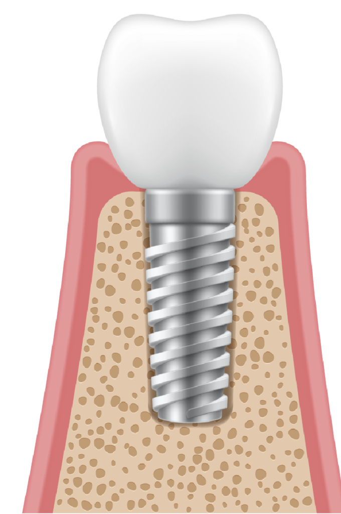 dental implant procedure: healing