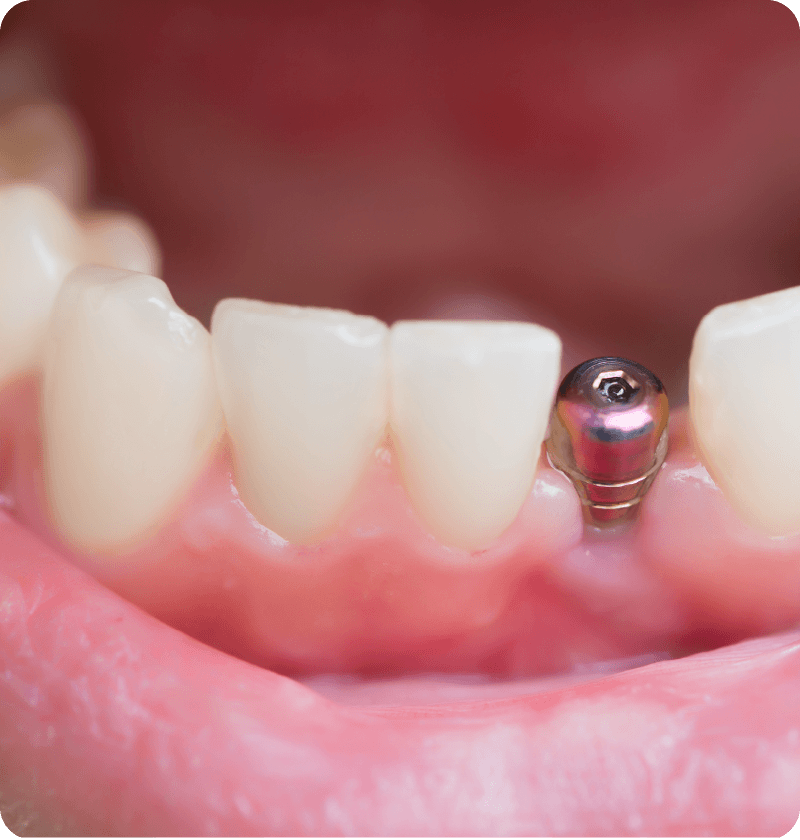 dental implant procedure: replace the missing teeth