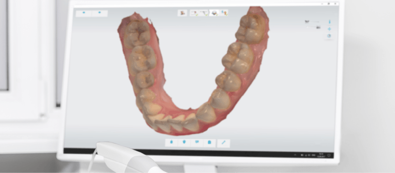 invisible aligners