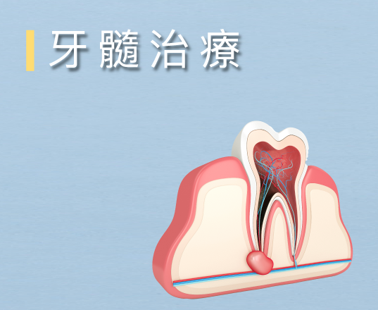 牙髓治療