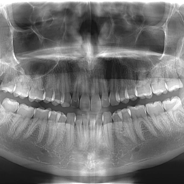 牙齒 CT Scan